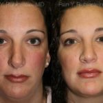 Revision Rhinoplasty Before and After Photos in Montvale, NJ, Patient 13002