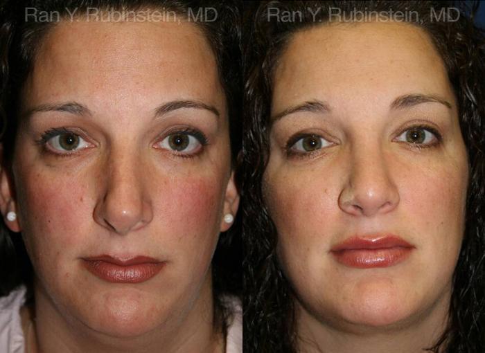 Revision Rhinoplasty Before and After Photos in Montvale, NJ, Patient 13002