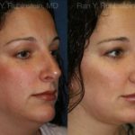 Revision Rhinoplasty Before and After Photos in Montvale, NJ, Patient 13002
