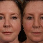 Revision Rhinoplasty Before and After Photos in Montvale, NJ, Patient 13009