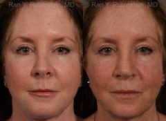 Revision Rhinoplasty Before and After Photos in Montvale, NJ, Patient 13009