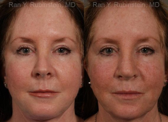 Revision Rhinoplasty Before and After Photos in Montvale, NJ, Patient 13009