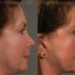 Revision Rhinoplasty Before and After Photos in Montvale, NJ, Patient 13009
