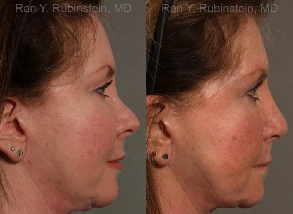 Revision Rhinoplasty Before and After Photos in Montvale, NJ, Patient 13009