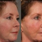 Revision Rhinoplasty Before and After Photos in Montvale, NJ, Patient 13009