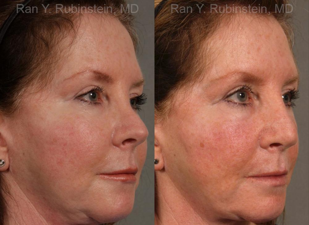 Revision Rhinoplasty Before and After Photos in Montvale, NJ, Patient 13009