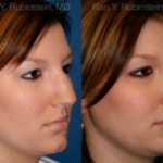 Rhinoplasty Before and After Photos in Montvale, NJ, Patient 13016