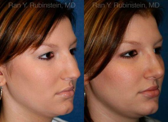 Rhinoplasty Before and After Photos in Montvale, NJ, Patient 13016