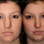 Rhinoplasty Before and After Photos in Montvale, NJ, Patient 13016