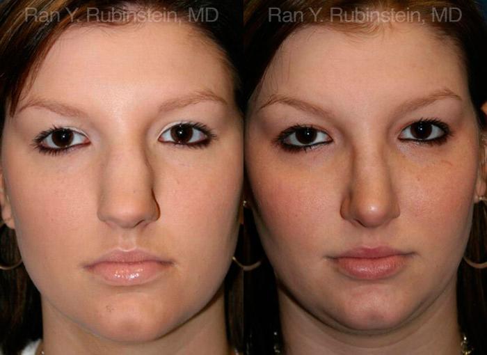 Rhinoplasty Before and After Photos in Montvale, NJ, Patient 13016