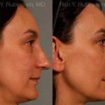 Rhinoplasty Before and After Photos in Montvale, NJ, Patient 13021
