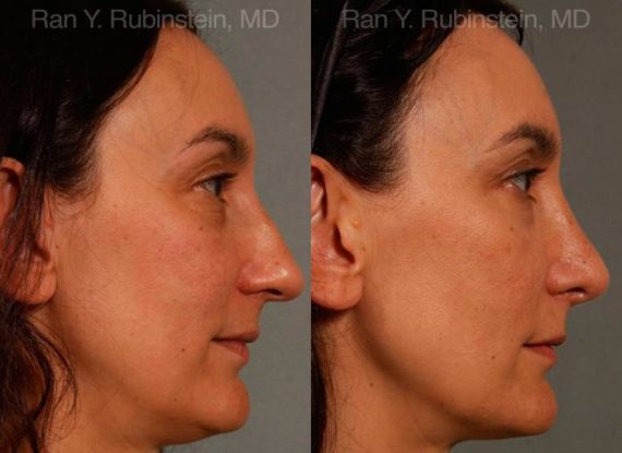 Rhinoplasty Before and After Photos in Montvale, NJ, Patient 13021