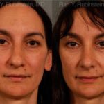 Rhinoplasty Before and After Photos in Montvale, NJ, Patient 13021