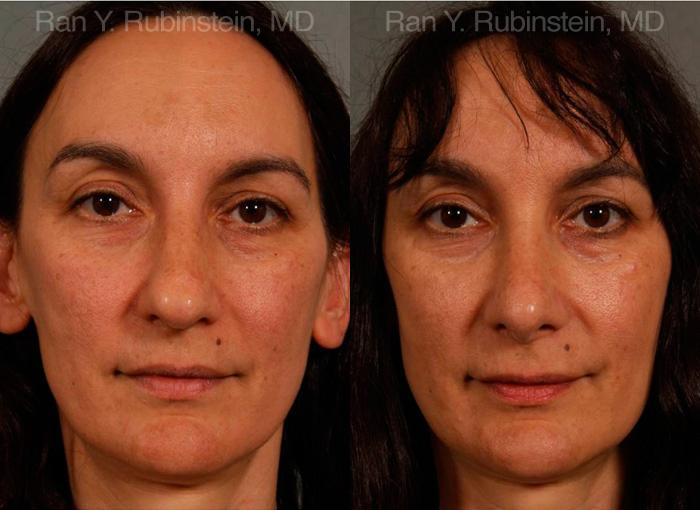 Rhinoplasty Before and After Photos in Montvale, NJ, Patient 13021