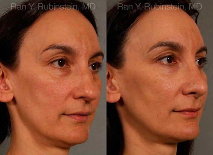 Rhinoplasty Before and After Photos in Montvale, NJ, Patient 13021