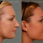 Rhinoplasty Before and After Photos in Montvale, NJ, Patient 13028