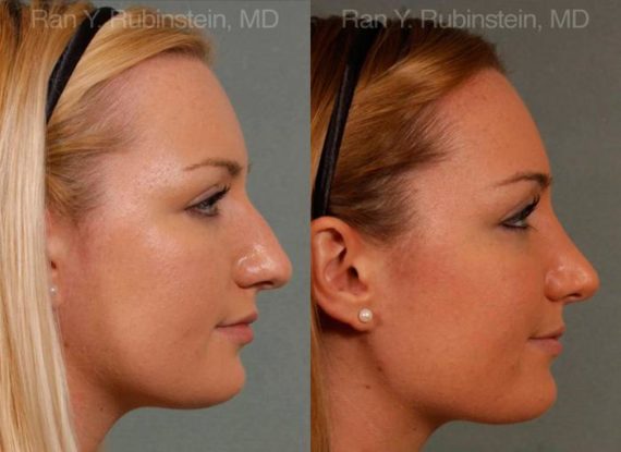 Rhinoplasty Before and After Photos in Montvale, NJ, Patient 13028