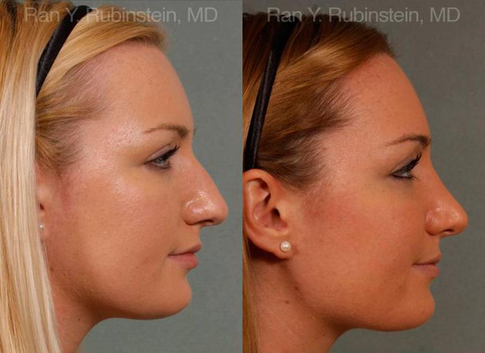 Rhinoplasty Before and After Photos in Montvale, NJ, Patient 13028