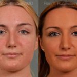 Rhinoplasty Before and After Photos in Montvale, NJ, Patient 13028
