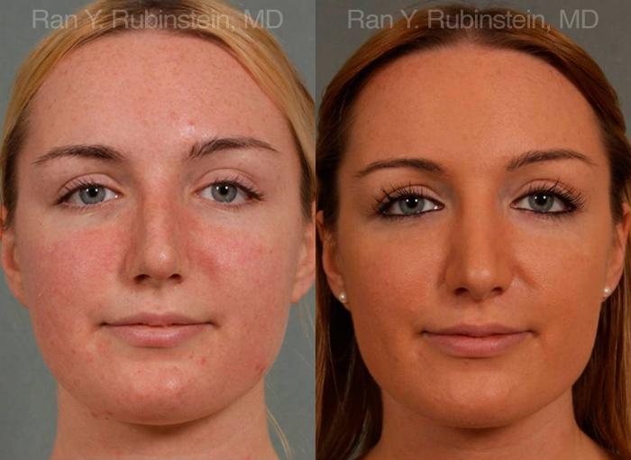 Rhinoplasty Before and After Photos in Montvale, NJ, Patient 13028