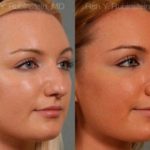 Rhinoplasty Before and After Photos in Montvale, NJ, Patient 13028