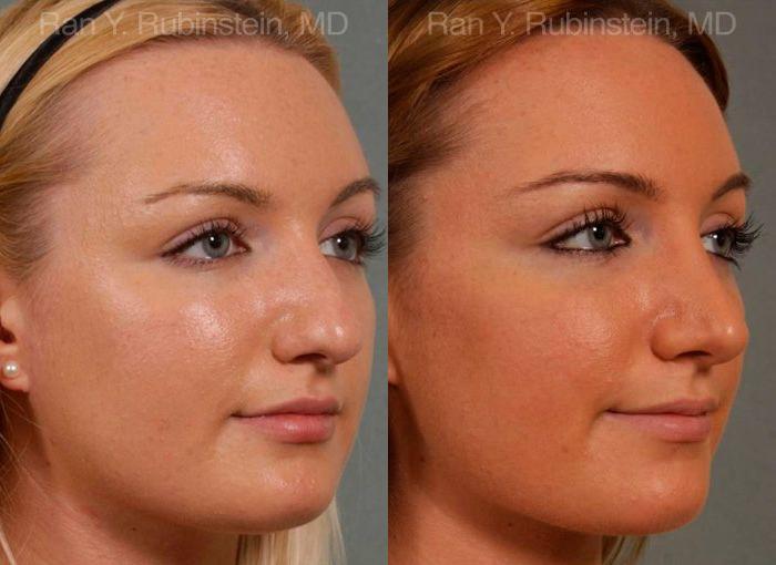 Rhinoplasty Before and After Photos in Montvale, NJ, Patient 13028