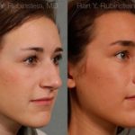 Rhinoplasty Before and After Photos in Montvale, NJ, Patient 13035