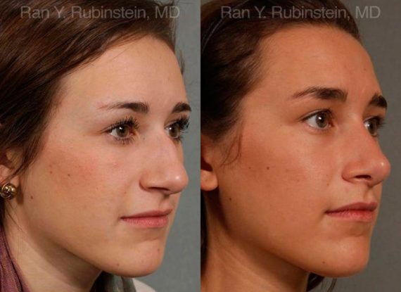 Rhinoplasty Before and After Photos in Montvale, NJ, Patient 13035