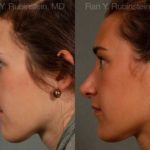 Rhinoplasty Before and After Photos in Montvale, NJ, Patient 13035