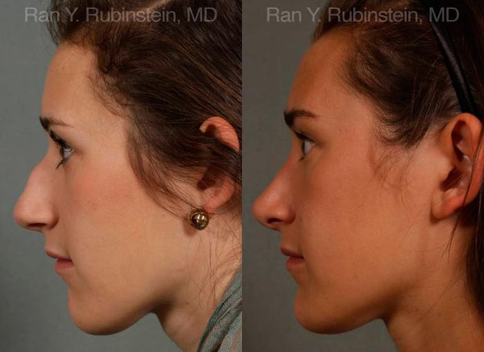 Rhinoplasty Before and After Photos in Montvale, NJ, Patient 13035