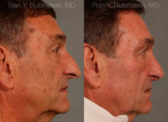 Rhinoplasty Before and After Photos in Montvale, NJ, Patient 13040
