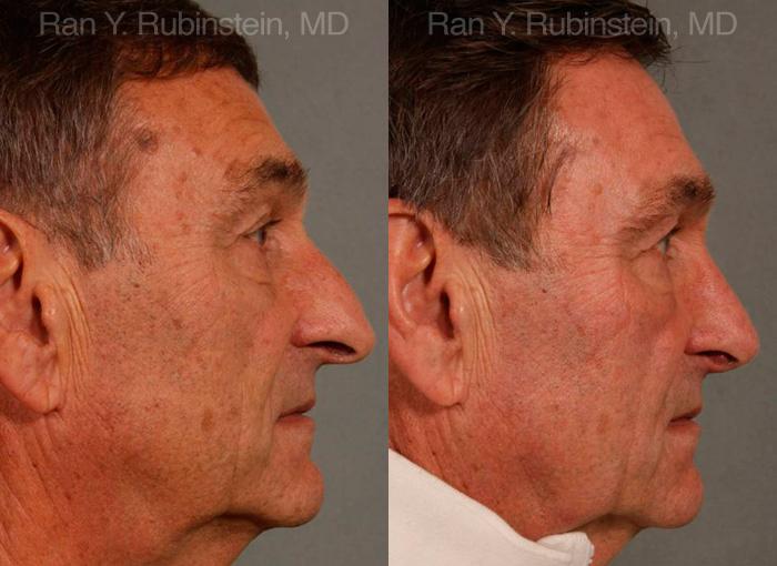 Rhinoplasty Before and After Photos in Montvale, NJ, Patient 13040