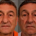 Rhinoplasty Before and After Photos in Montvale, NJ, Patient 13040