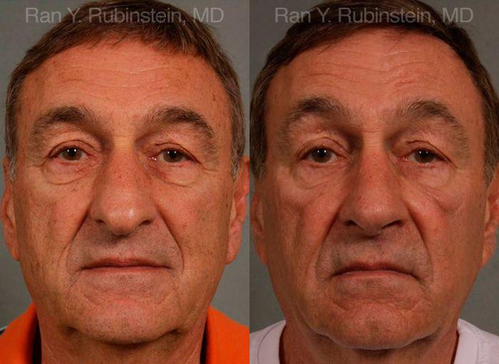 Rhinoplasty Before and After Photos in Montvale, NJ, Patient 13040