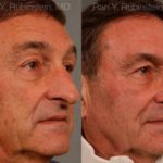 Rhinoplasty Before and After Photos in Montvale, NJ, Patient 13040