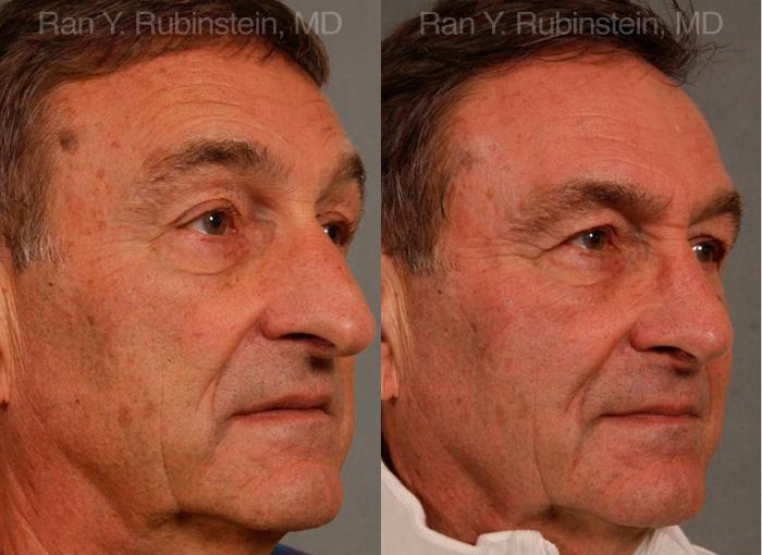 Rhinoplasty Before and After Photos in Montvale, NJ, Patient 13040