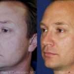 Rhinoplasty Before and After Photos in Montvale, NJ, Patient 13047