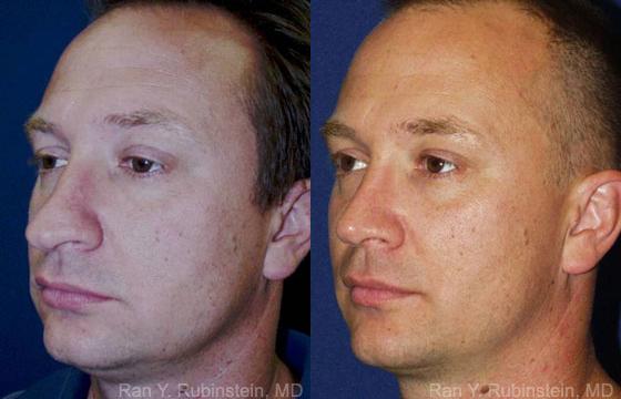 Rhinoplasty Before and After Photos in Montvale, NJ, Patient 13047