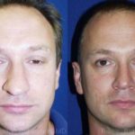 Rhinoplasty Before and After Photos in Montvale, NJ, Patient 13047