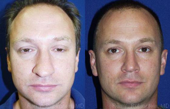 Rhinoplasty Before and After Photos in Montvale, NJ, Patient 13047