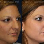 Rhinoplasty Before and After Photos in Montvale, NJ, Patient 13062