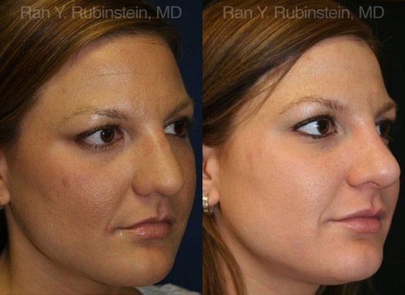Rhinoplasty Before and After Photos in Montvale, NJ, Patient 13062