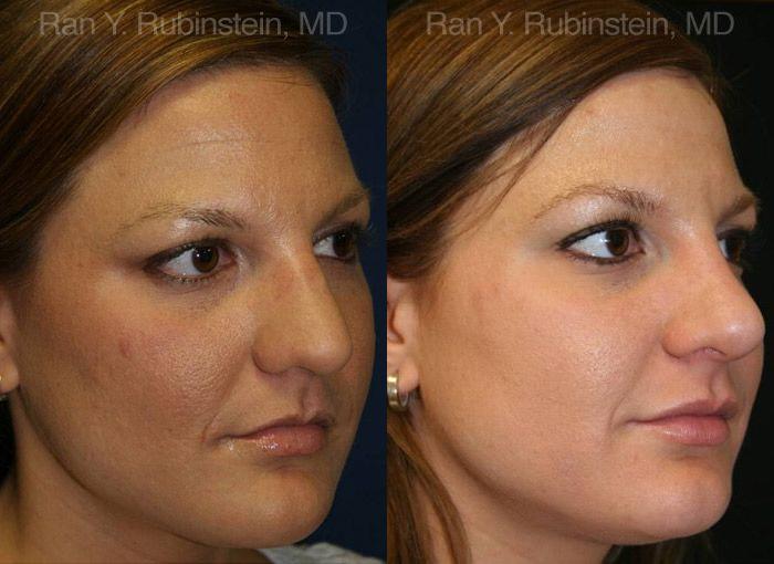 Rhinoplasty Before and After Photos in Montvale, NJ, Patient 13062