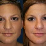 Rhinoplasty Before and After Photos in Montvale, NJ, Patient 13062