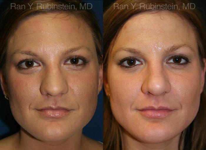Rhinoplasty Before and After Photos in Montvale, NJ, Patient 13062