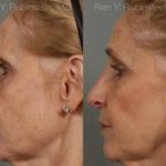 Rhinoplasty Before and After Photos in Montvale, NJ, Patient 13067