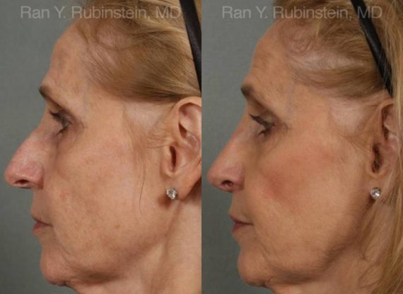 Rhinoplasty Before and After Photos in Montvale, NJ, Patient 13067