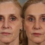Rhinoplasty Before and After Photos in Montvale, NJ, Patient 13067