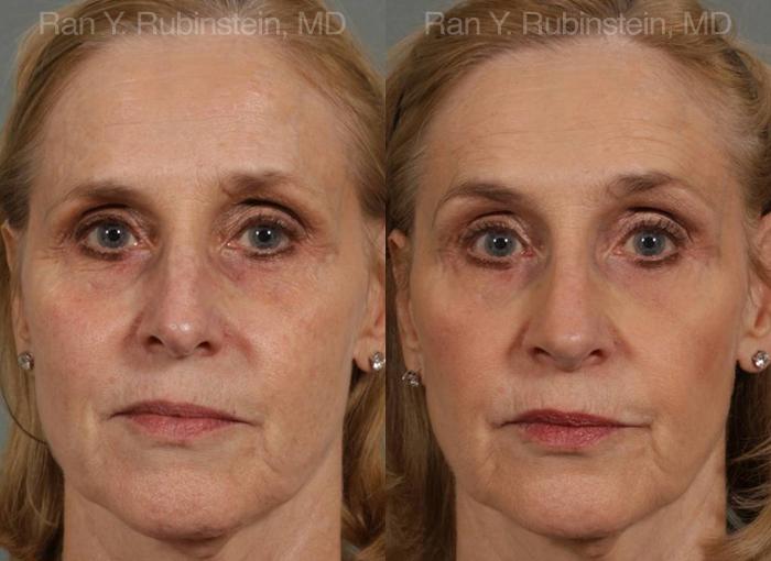 Rhinoplasty Before and After Photos in Montvale, NJ, Patient 13067
