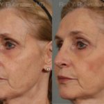 Rhinoplasty Before and After Photos in Montvale, NJ, Patient 13067